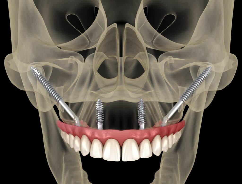 zygoma implantátum