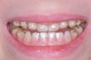 Invisalign gyermekeknek Zalaegerszeg